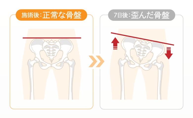 施術後：正常な骨盤と7日後：歪んだ骨盤